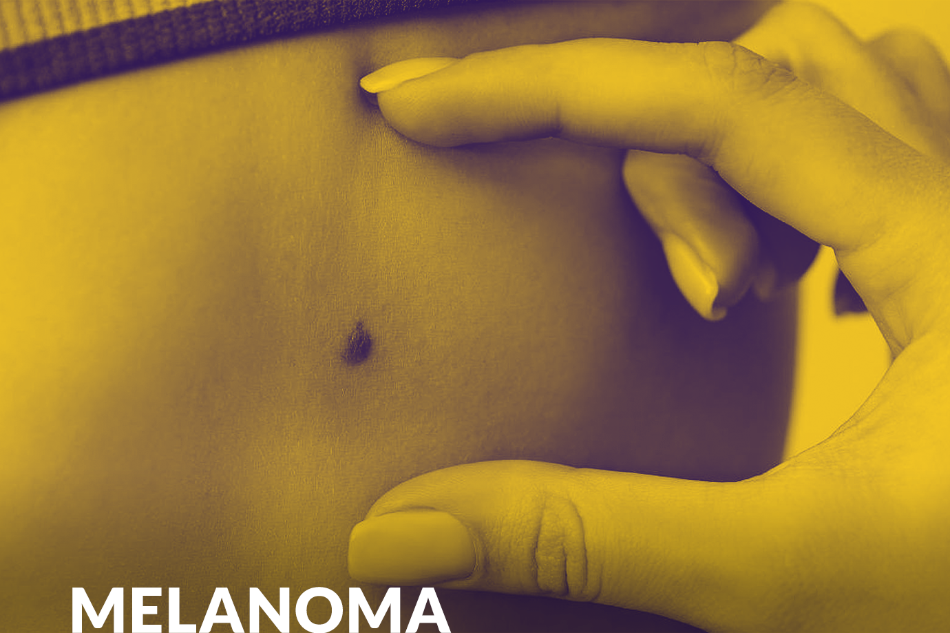 Câncer de pele melanoma