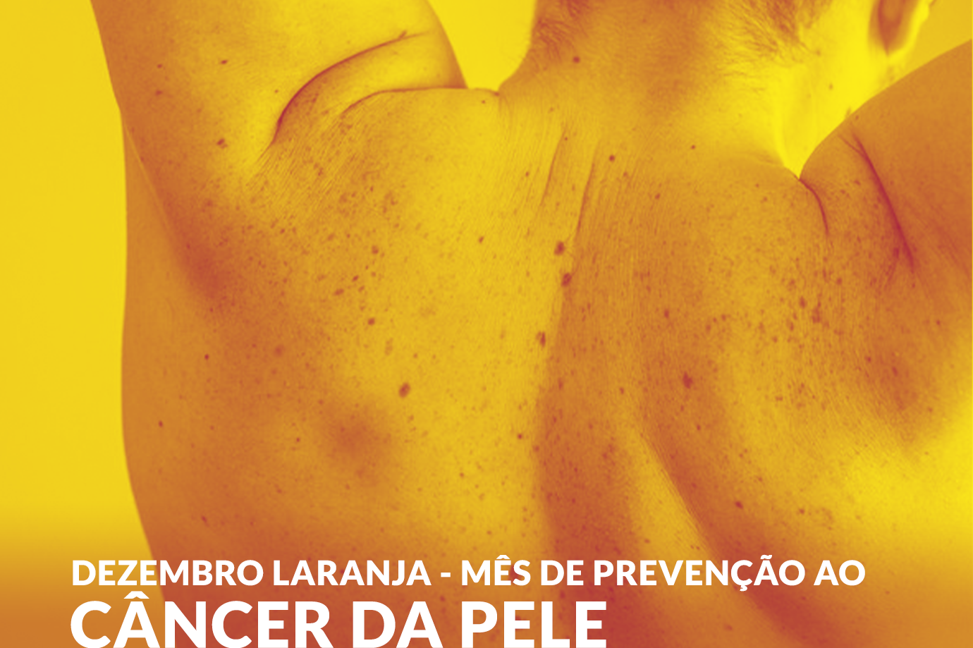 Dezembro Laranja – Mês de Prevenção ao Câncer de pele